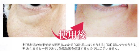アイキララ 目の下のたるみ