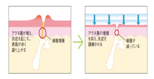 ファンケルニキビケア